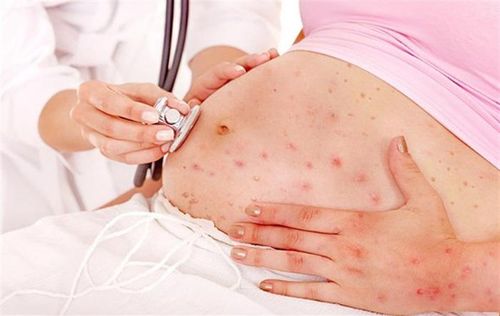 Thủy đậu ở phụ nữ mang thai được xem là vấn đề lớn trong thai kỳ - Ảnh: kidborn
