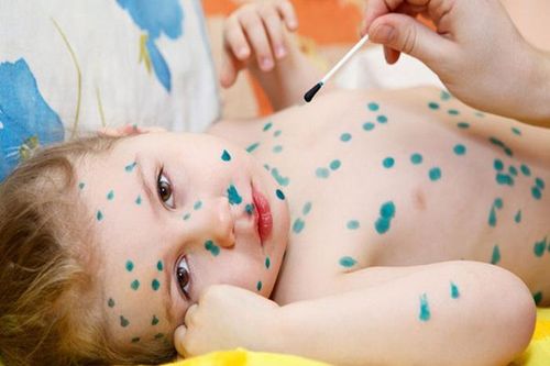 Xanh methylen bôi sát trùng ngoài da cho bệnh nhân thủy đậu rất ít gây tác dụng phụ cho bệnh nhân (Ảnh: Internet)