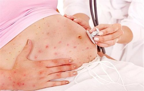 Chẩn đoán bệnh thủy đậu ở bà bầu giúp mẹ và bé an toàn, khỏe mạnh trong suốt thai kỳ - Ảnh: Internet