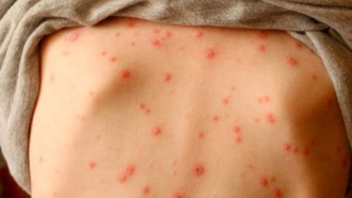 Tự kiểm tra bệnh thủy đậu tại nhà cần lưu ý đến các dấu hiệu đặc trưng - Ảnh: Internet
