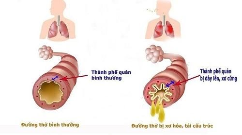  Tái cấu trúc đường thở là nguyên nhân cốt lõi gây ra các bệnh đường hô hấp, trong đó có hen và COPD.