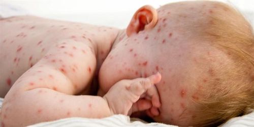 Các nốt ban xuất hiện trên người trẻ nhỏ bị thủy đậu (Ảnh: dizigon.vn)