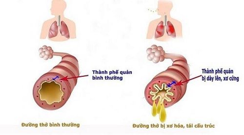 Quá trình xơ hóa, tái cấu trúc đường thở là nguyên nhân cốt lõi gây ra các bệnh đường hô hấp, trong đó có hen và COPD.