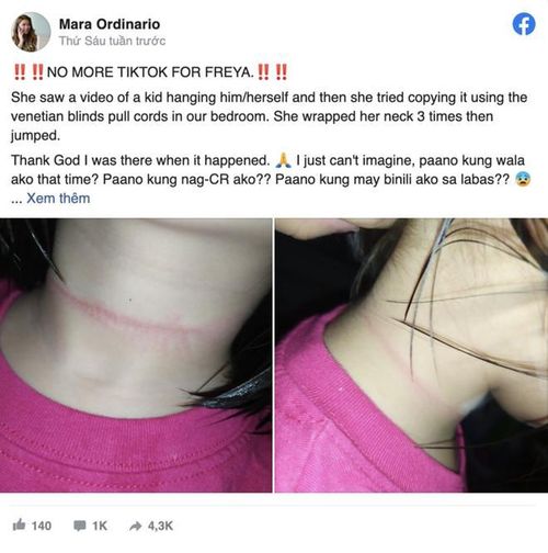 Cô bé 4 tuổi và vết hằn trên cổ.