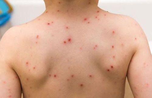 Bệnh Rubella bao lâu thì khỏi là vấn đề thắc mắc của rất nhiều người (Ảnh: Internet)