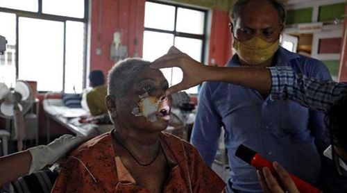 Căn bệnh nấm đen khiến bệnh nhân xuất hiện những “lỗ” kỳ quái trên mặt Ảnh: Reuters.