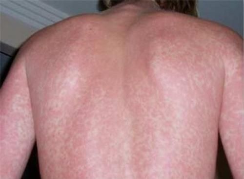 Phát ban thường xuất hiện vào cuối chu kỳ của bệnh