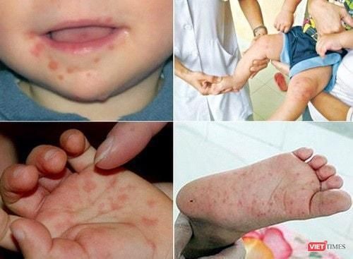 Sốt xuất huyết và tay chân miệng vẫn tiếp tục hoành hành với số bệnh nhân tăng cao