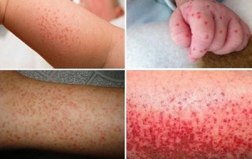 Các dấu hiệu nguy hiểm trong bệnh sốt xuất huyết.