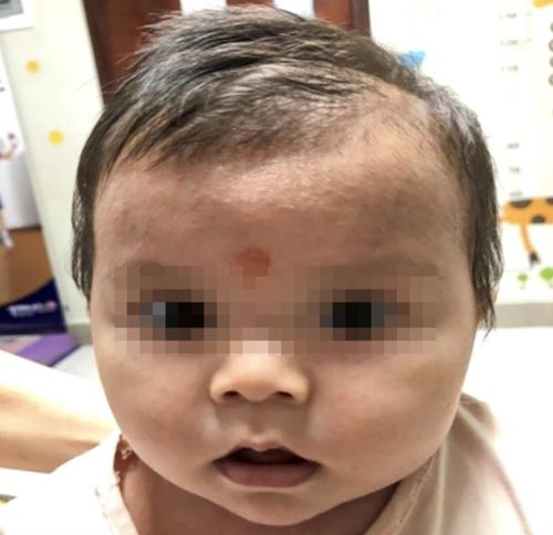 Một trẻ bị rôm sảy. Ảnh: Bệnh viện cung cấp.