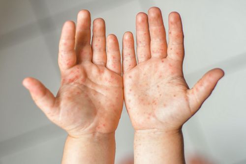 Biểu hiện phổ biến của trẻ khi mắc tay chân miệng là các vết rát đỏ, mụn nước ở da. Ảnh: BPO.