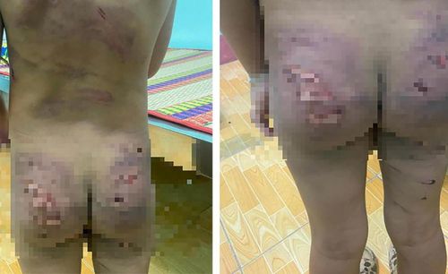 Vết thương đầy lưng bé gái 7 tuổi