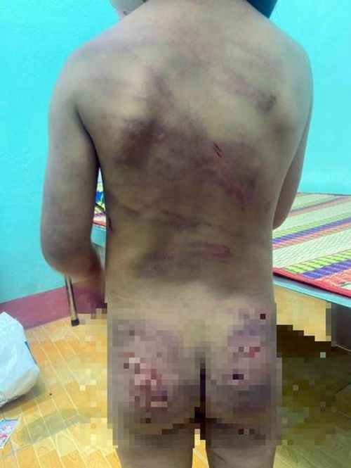 Bé D. với vết thương chằng chịt do mẹ đẻ và cha dượng đánh đập