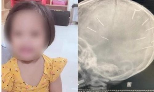  Bé gái 3 tuổi bị cắm 9 cây đinh vào đầu: Chiều 17/1/2022, Bệnh viện Thạch Thất đã tiếp nhận bé Đ.N.A. nhập viện trong tình trạng hôn mê, co giật. Đáng chú ý, sau khi các bác sĩ tiếp nhận bệnh nhân, tiến hành đặt ống, chụp phim đã phát hiện trên hộp sọ cháu bé có 9 cái đinh. Trong quá trình kiểm tra, thăm khám, các bác sĩ phát hiện cánh tay phải của bé đã được bó bột trong 2 tuần. 