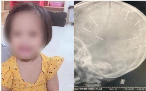 Bé Đ.N.A. bị người tình của mẹ đóng 9 cái đinh vào đầu (Ảnh: TL)