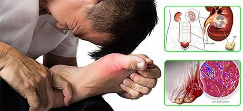 Các cơn gút thường xảy ra vào ban đêm, sau các bữa ăn giàu đạm và kéo dài 3-10 ngày (Ảnh minh họa)