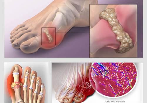 Hình ảnh tổn thương do bệnh gout.