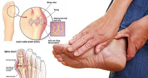 Cơn gout cấp xuất hiện đột ngột ban đêm, bệnh nhân thức dậy vì đau ở khớp.