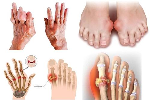 Người bệnh cần điều chỉnh chế độ ăn uống- sinh hoạt là một trong những yếu tố quan trọng để phòng ngừa và điều trị bệnh gout.