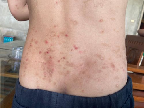  Người dân bị côn trùng đốt gây sẩn, ngứa 