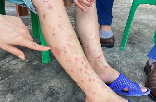  Những vùng sẩn huyết thanh có vết đốt ở giữa. Ảnh: CDC Hà Tĩnh. 