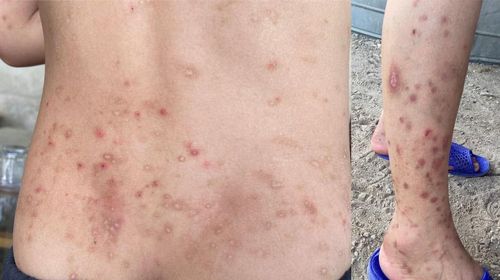 Người dân bị côn trùng đốt gây ra viêm da tiếp xúc