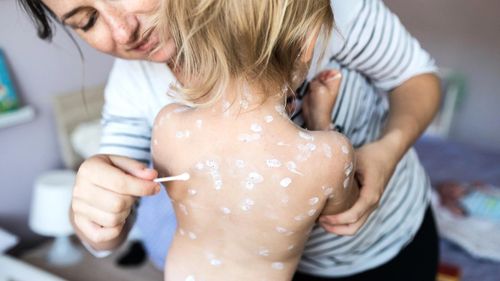  Một số loại thuốc có thể giúp trẻ giảm ngứa khi bị thủy đậu. Ảnh: Sheknows. 