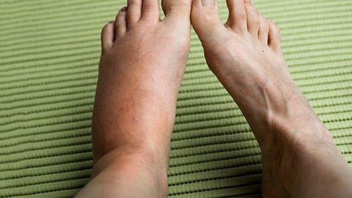 Ong đốt thường gây sưng và đau nhói âm ỉ (Ảnh: Everydayhealth)