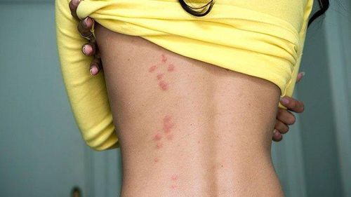 Rệp cắn sẽ xuất hiện nhiều vết đỏ tập trung lại và tạo thành một đường (Ảnh: Everydayhealth)