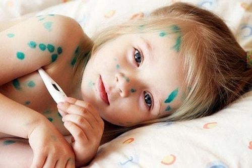 Thủy đậu nếu chăm sóc không đúng các mụn nước sẽ có thể viêm da bội nhiễm, để lại sẹo lõm trên da. Ảnh minh họa.