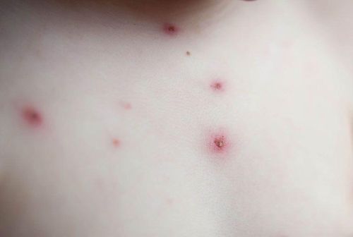 Mụn nước là một trong những triệu chứng điển hình của thủy đậu. Ảnh minh họa: Which. 