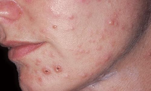 Sẹo lõm thủy đậu không gây ảnh hưởng về mặt sức khỏe, tuy nhiên lại gây ảnh hưởng về mặt thẩm mỹ đặc biệt là ở các vùng như mặt và cổ, và những vùng dễ nhìn thấy.