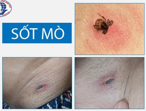 Hình ảnh nốt mò điển hình của bệnh sốt mò.