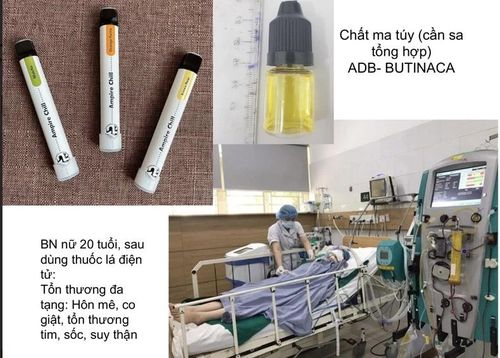 Một bệnh nhân cấp cứu tại Trung tâm chống độc sau khi dùng thuốc lá điện tử có chất ma túy.