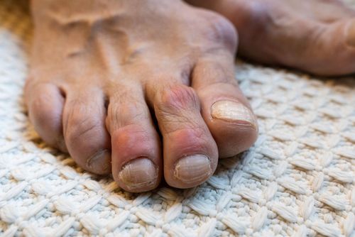 Khoảng 80-90% trường hợp bị gout là nam giới và đa số khởi phát ở độ tuổi trung niên.