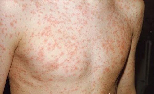 Trẻ mắc sởi thường bị sốt phát ban