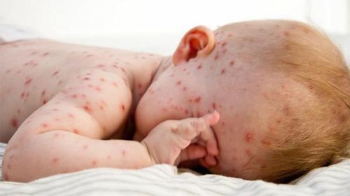Trẻ cần được tiêm vaccine phòng bệnh sởi đúng lịch, đủ liều. (Ảnh minh họa)