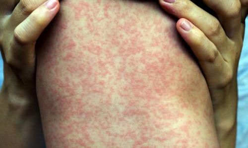 Số ca mắc bệnh sởi tăng nhanh ở Việt Nam