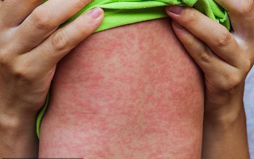 Số ca phát ban nghi sởi từ đầu năm đến nay ở nước ta đã tăng 2,7 lần so với cùng kỳ năm 2023. Thời gian tới có thể tiếp tục ghi nhận một số ca mắc mới, các ổ dịch, nhất là tại những nơi có tỷ lệ tiêm chủng thấp trong thời gian qua...