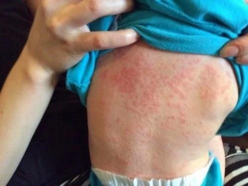 Vết ban sởi sẩn gồ ở lưng bệnh nhi. Ảnh: Bệnh viện Nhi Trung ương.