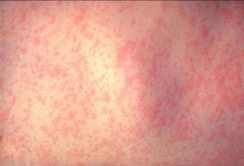 Da một bệnh nhân sau ba ngày nhiễm virus sởi. Ảnh minh họa 