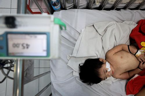  Buổi sáng, bé Bảo Thy đột ngột khó thở, cả người tím tái, buộc phải thở oxy. 5 ngày trước, bé sốt cao, mặt nổi ban lốm đốm khi đang nằm viện để điều trị bệnh viêm khớp thiếu niên tự phát. Bé Thy được chuyển đến phòng cách ly bệnh sởi ngay lập tức. Đứa trẻ 2 tuổi sốt cao, ngủ mê man, mất đi vẻ hiếu động trước đây. “Sau khi chuyển về quê, điều kiện kinh tế khó khăn, tôi đã quên mất việc tiêm vaccine cho bé. Đến khi phát hiện bệnh thì đã trở nặng thế này”, chị Trần Kim Như (25 tuổi, Cà Mau), mẹ bé Thy, tâm sự. 