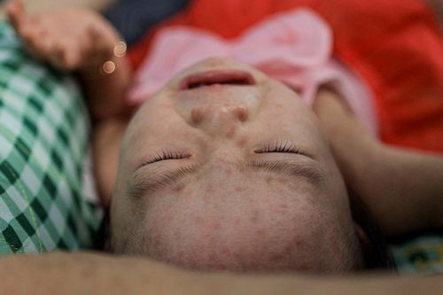  Các nốt phát ban đỏ trên trán, mặt, cổ... của một trẻ nhỏ mắc bệnh sởi. 