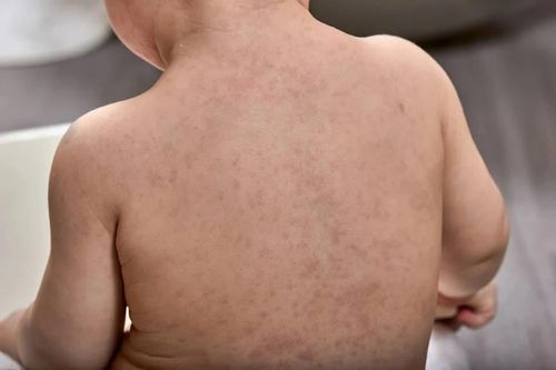 Sởi và sốt phát ban là 2 bệnh do virus truyền nhiễm khác nhau nhưng có nhiều triệu chứng tương tự. Ảnh minh họa: Happiestbaby.
