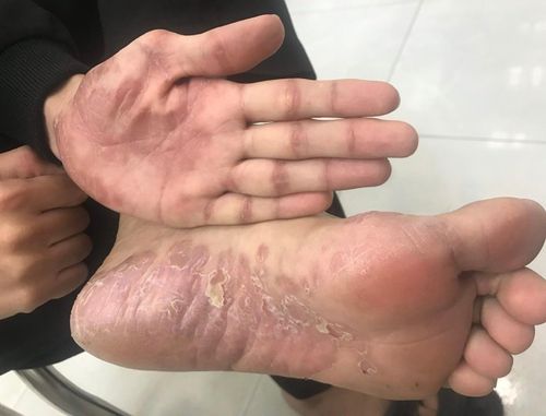  Người mắc bệnh giang mai bị tổn thương da. Ảnh: BVCC. 