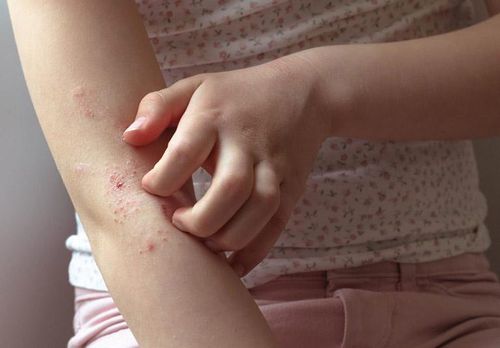 Mùa xuân là thời điểm nhiều người bị ngứa da.