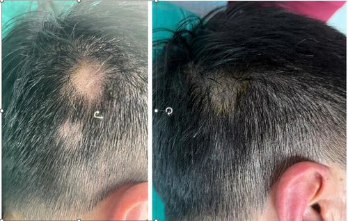 Hình ảnh hiệu quả điều trị của bệnh nhân nam, 54 tuổi, chẩn đoán rụng tóc mảng sau 2 tháng điều trị tại Khoa Da liễu và Bỏng, Bệnh viện Bạch Mai - Ảnh BVCC