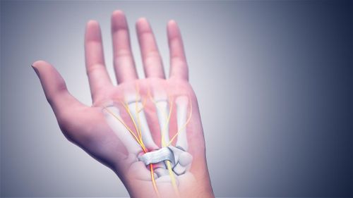 Khi vận động bàn tay, cổ tay nhiều, lặp lại trong thời gian dài sẽ gây ra tình trạng sưng nề, phù nề, tổn thương chèn ép dây thần kinh giữa.