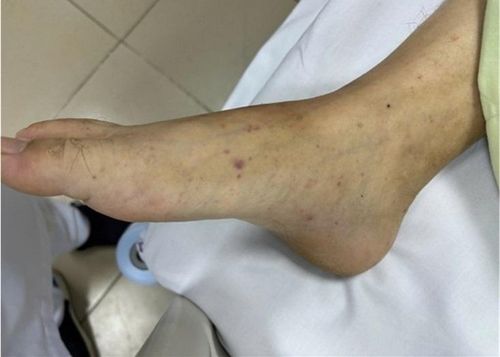  Ban xuất huyết trên cơ thể người bệnh. Ảnh: BVCC. 