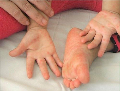 Tính đến tuần 12, toàn khu vực phía Nam ghi nhận 17.078 ca mắc tay chân miệng.